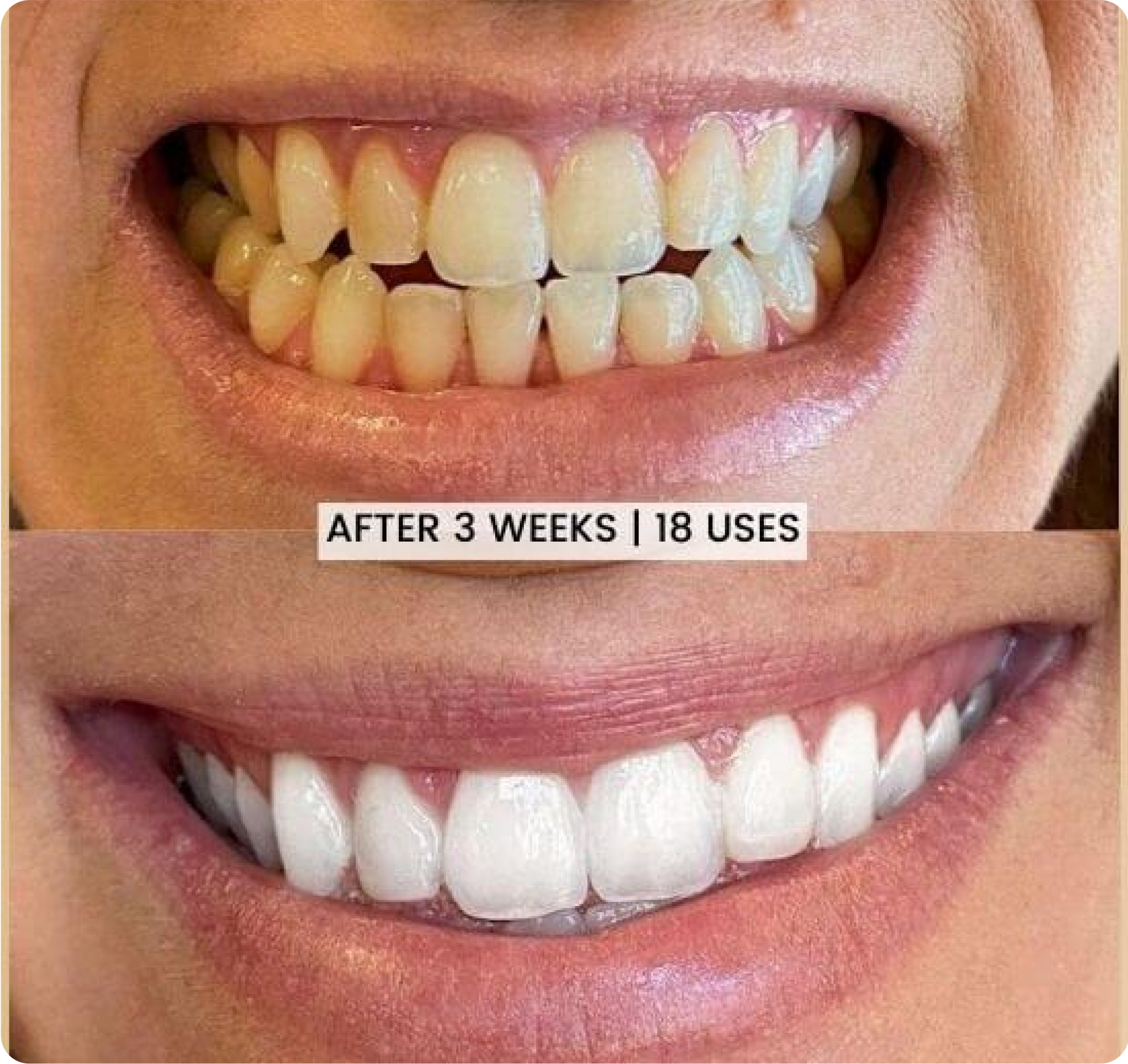 Teeth Whitening Kit - No Sensitivity LED Whitening Light