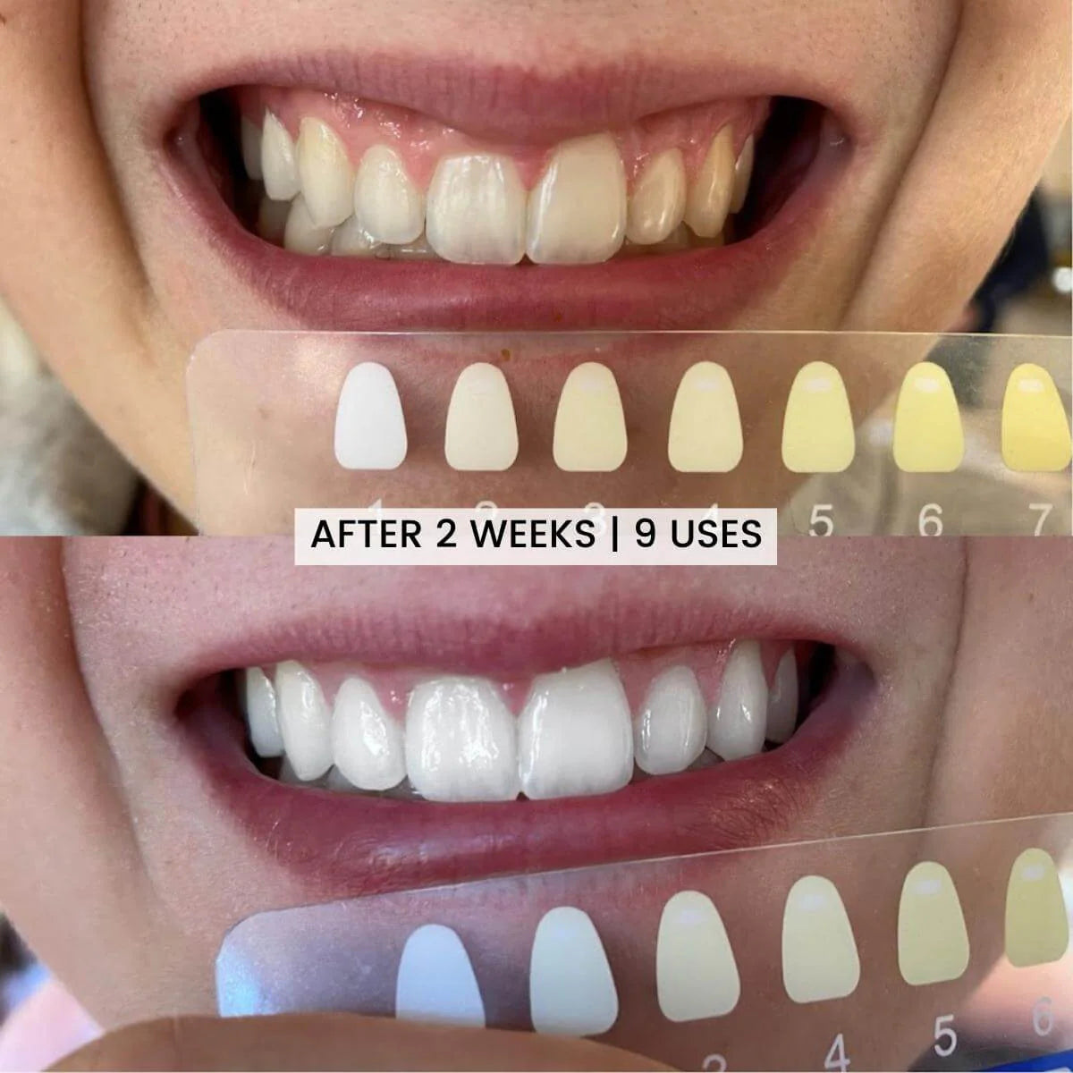 Teeth Whitening Kit - No Sensitivity LED Whitening Light